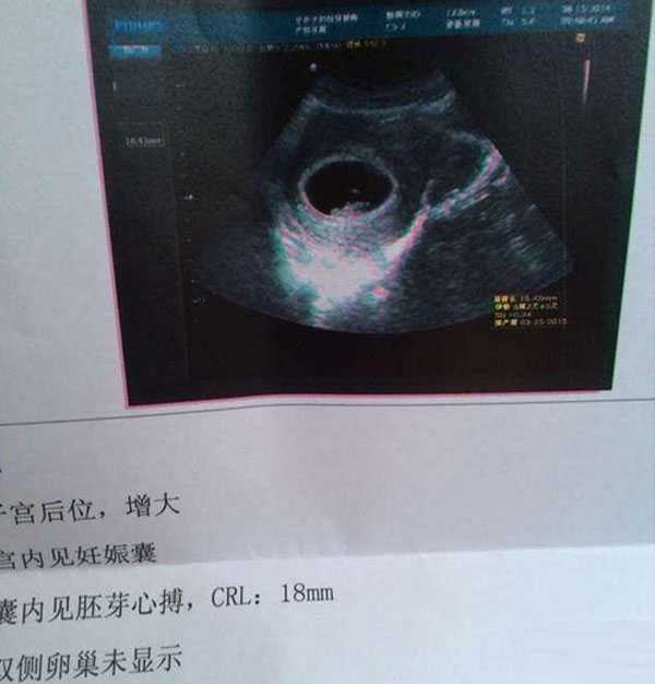重庆借卵子生子流程，试管移植39天是正常怀孕多少天，从孕囊大小怎么算孕周